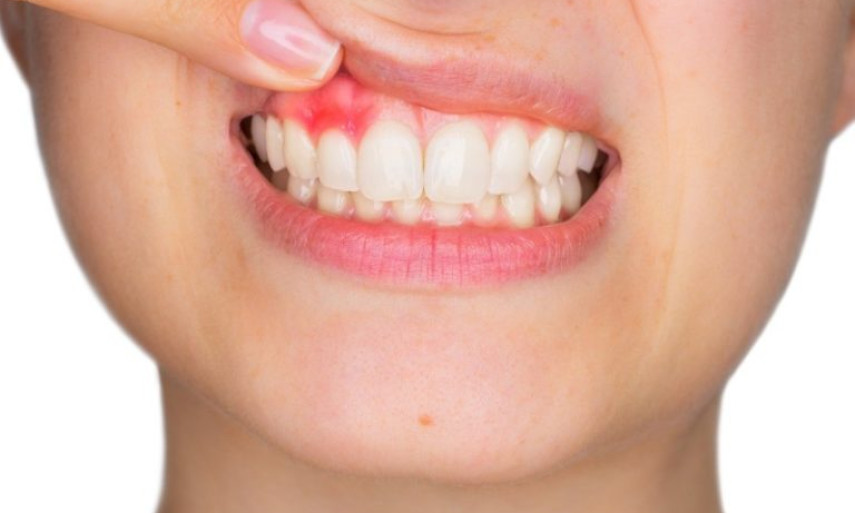 WHO: 45% dân số thế giới mắc các bệnh về răng miệng 
