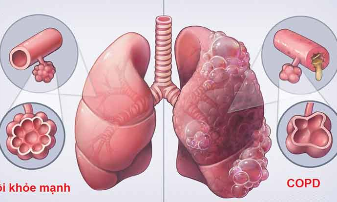 Phòng, chống bệnh phổi tắc nghẽn mạn tính