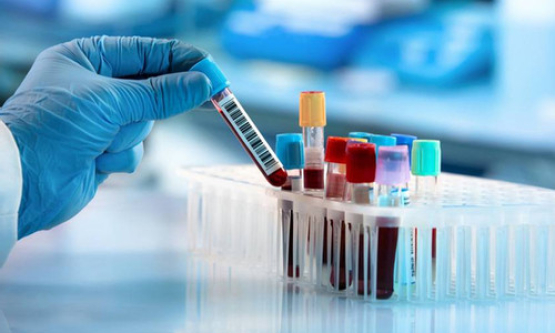 Mối liên hệ giữa nhóm máu và nguy cơ đột quỵ