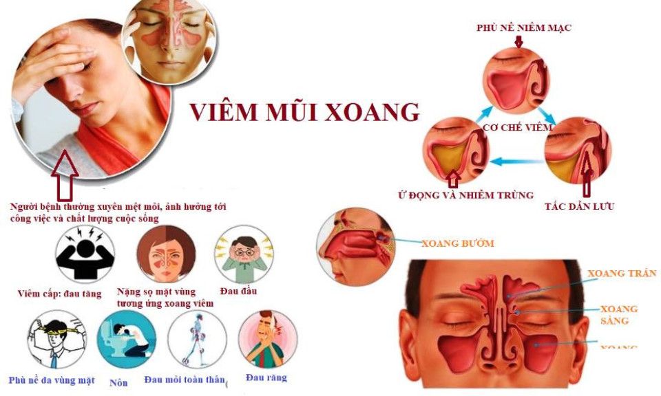Sáu thói quen xấu khiến nhiều người mắc viêm mũi xoang