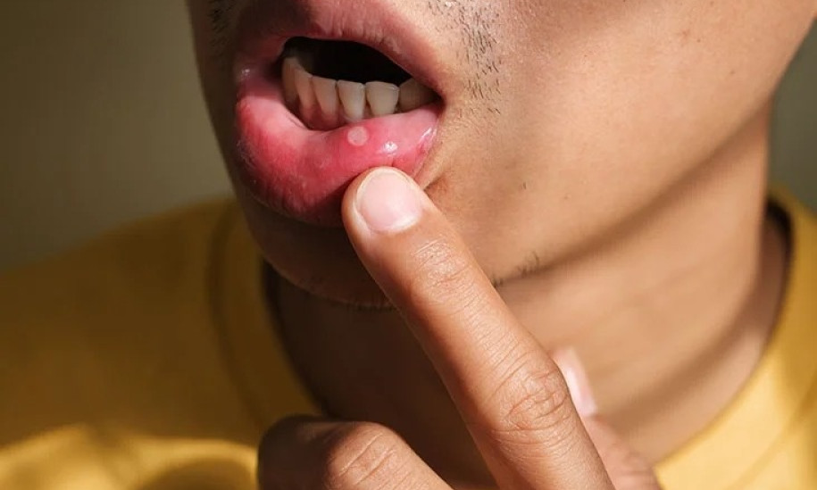Phương pháp xử lý nhanh nhiệt miệng