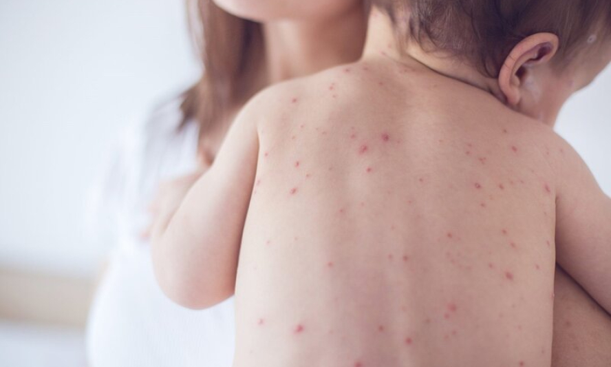 Sốt xuất huyết trái mùa