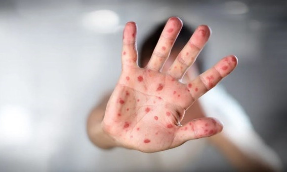 Hàn Quốc có ca bệnh đậu mùa khỉ đầu tiên lây truyền trong nước