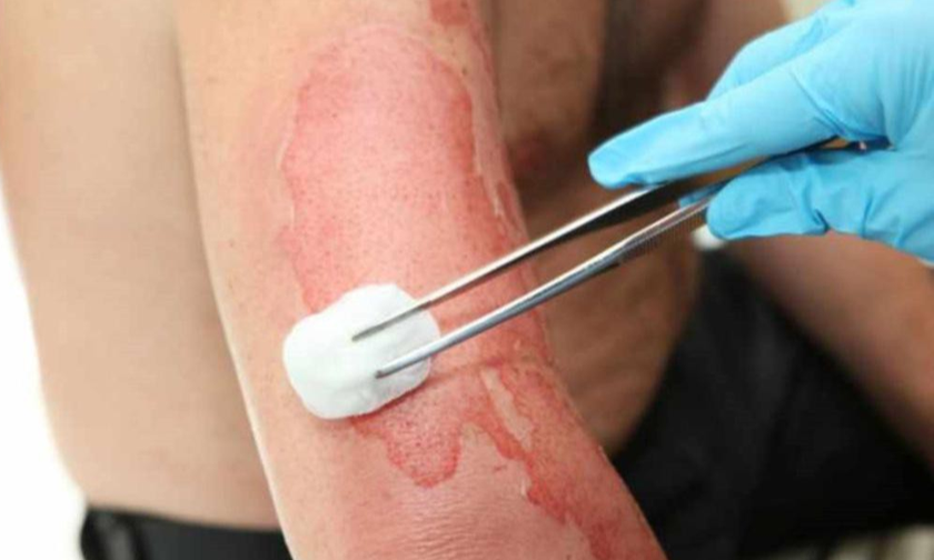 Chuyên gia cảnh báo bỏng lửa cồn vào mùa hè
