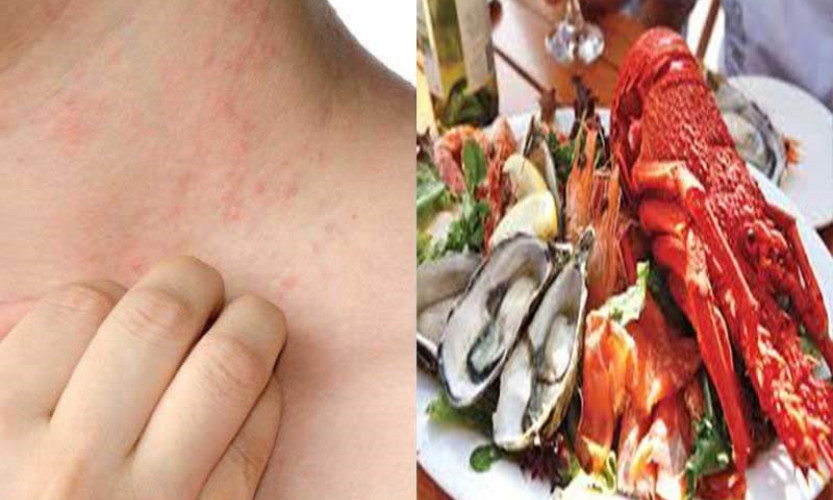 Những loại dị ứng phổ biến nhất