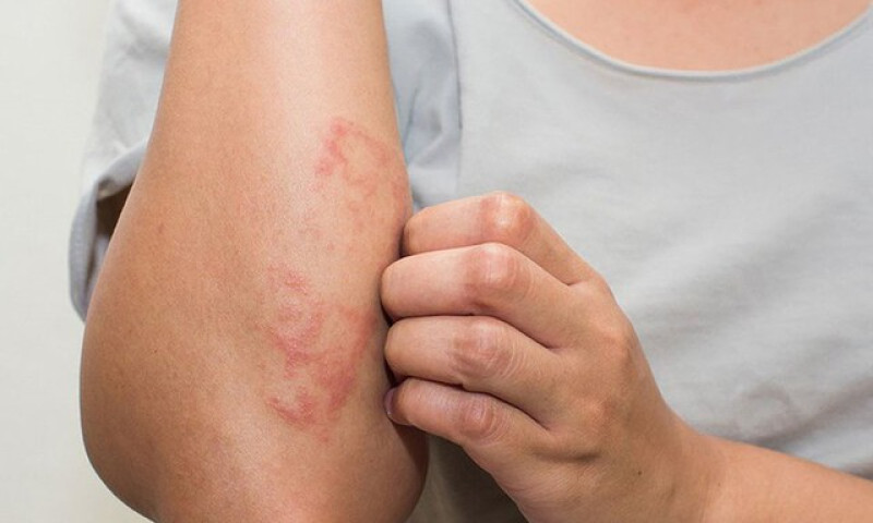 Các bệnh da do virus hay gặp vào mùa nắng nóng