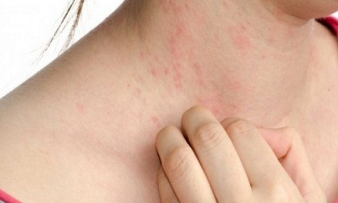 Cách phòng ngừa các bệnh dị ứng khi trời nóng nực