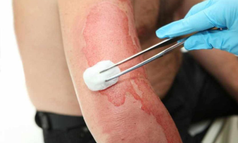 Bị bỏng phải kiêng trứng, thịt bò để vết sẹo 'đẹp', có đúng?
