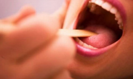 Đốm trắng trên amidan cảnh báo bệnh gì?