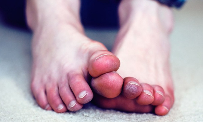 Dấu hiệu ở bàn chân chứng tỏ bạn đang có đường huyết quá cao