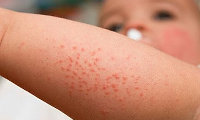 Sốt xuất huyết 'vào mùa' sớm