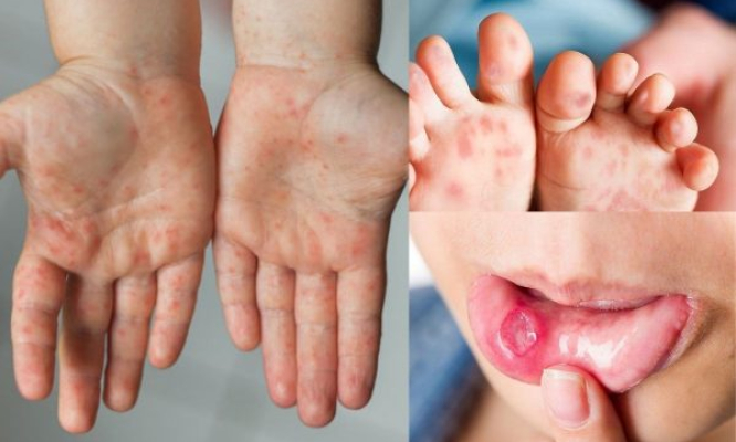 Không chủ quan với bệnh tay chân miệng