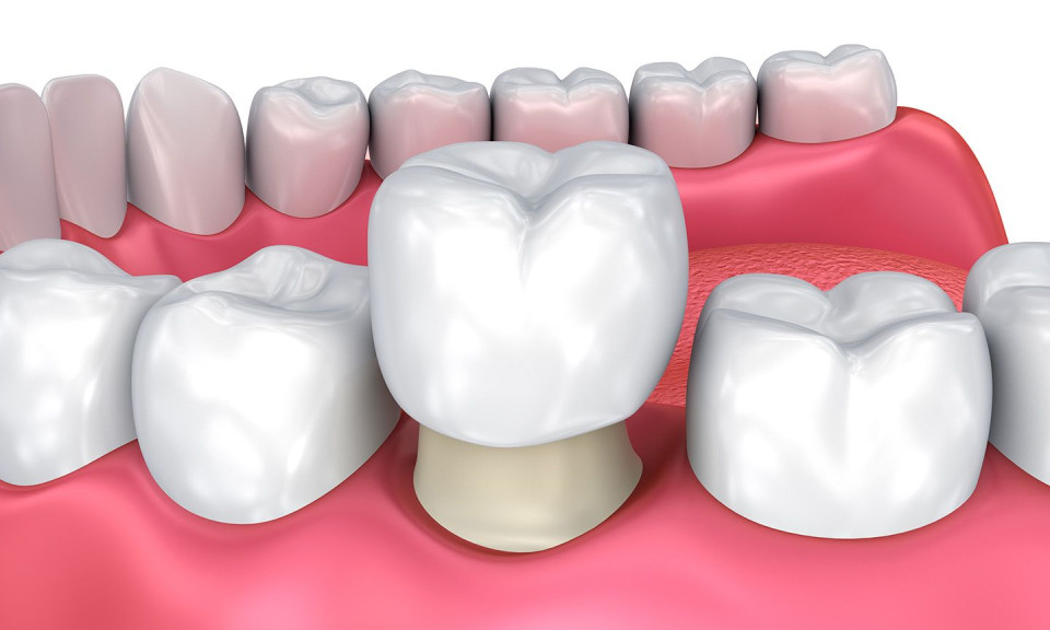 8 mối nguy từ việc bọc răng sứ không đảm bảo chất lượng