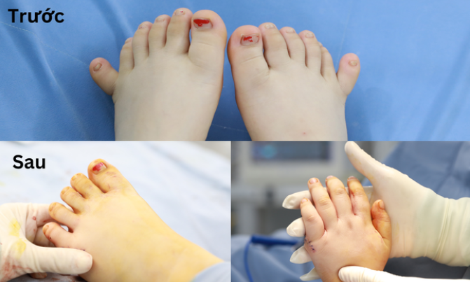 Em bé có 12 ngón tay, 12 ngón chân cực kỳ hiếm gặp