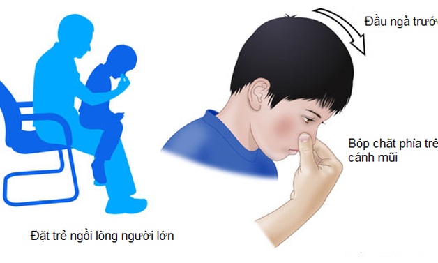 Chảy máu cam ở trẻ: Khi nào cần lo lắng?