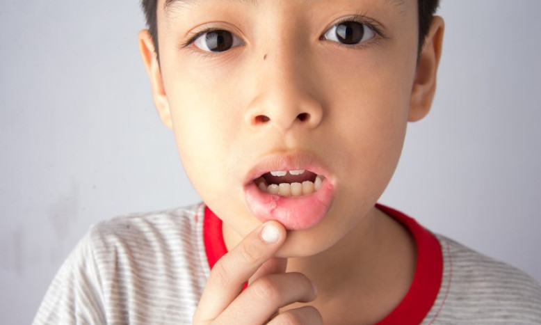 Chuyên gia chia sẻ cách chăm sóc cho trẻ khi bị nhiệt miệng