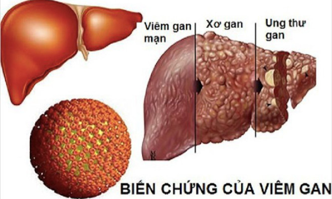 Làm gì để viêm gan B không biến chứng ung thư gan?