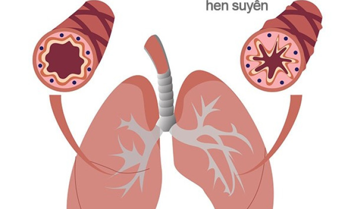 3 lưu ý kiểm soát hen người bệnh cần biết