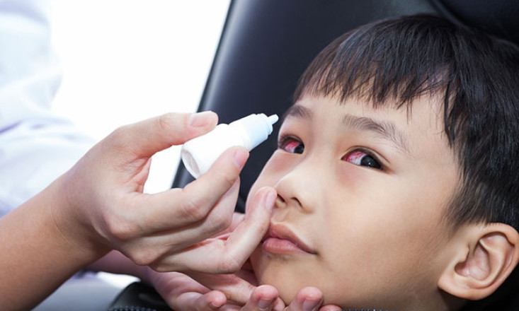 Dịch đau mắt đỏ vào mùa, bé có 5 dấu hiệu sau cha mẹ cần cho con đi khám ngay