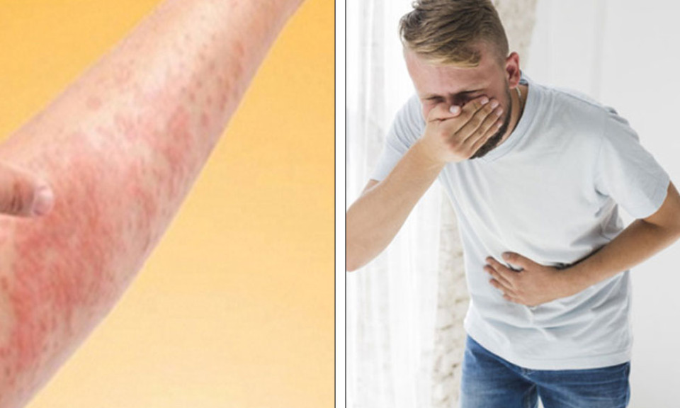Cách nhận biết giữa dị ứng thực phẩm và ngộ độc thực phẩm