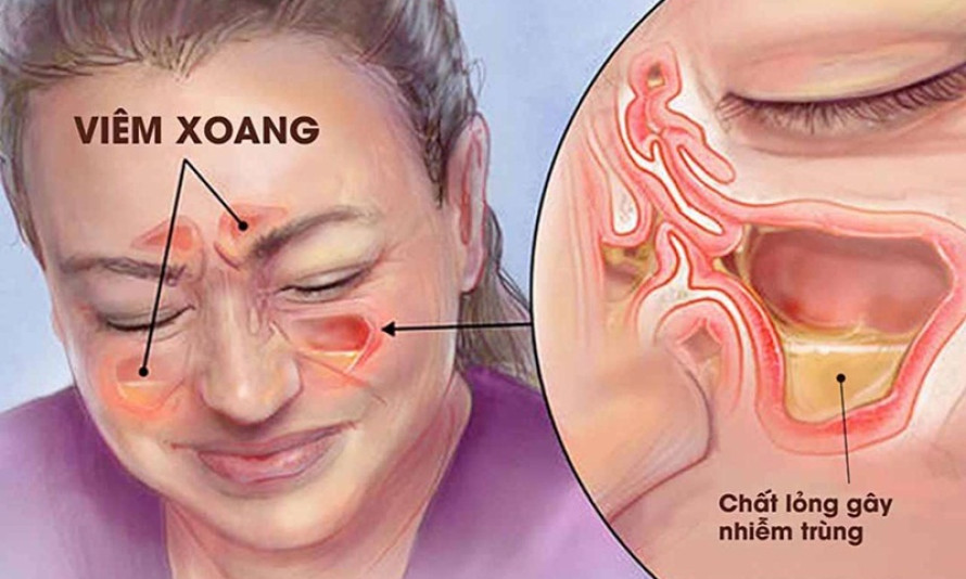 Người bị viêm xoang cấp cần lưu ý những gì?