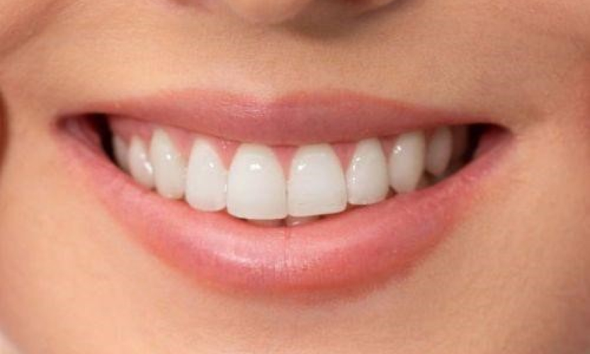 Bọc răng sứ có tốt không? 4 lợi ích điển hình