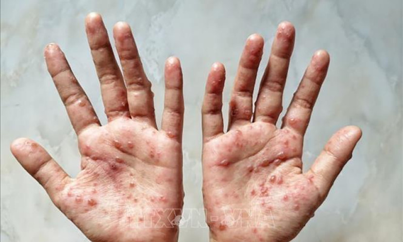 Phát hiện trường hợp mắc bệnh đậu mùa khỉ đầu tiên tại Lào