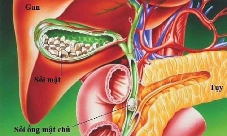 5 triệu chứng cảnh báo sỏi túi mật bạn cần biết