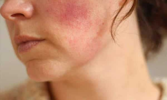 Biến chứng "chết người" khi lạm dụng, tự ý dùng Corticoid