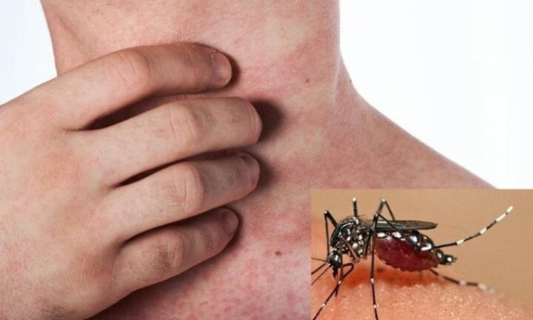 Việt Nam sẽ tiêm thử nghiệm vaccine sốt xuất huyết của Nhật Bản