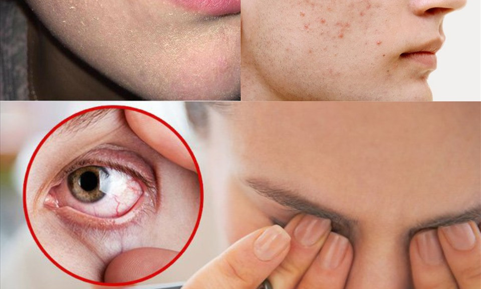 Dấu hiệu làn da thiếu vitamin và cách bổ sung