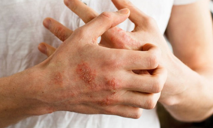 Bệnh về da hay gặp vào mùa đông và cách hạn chế