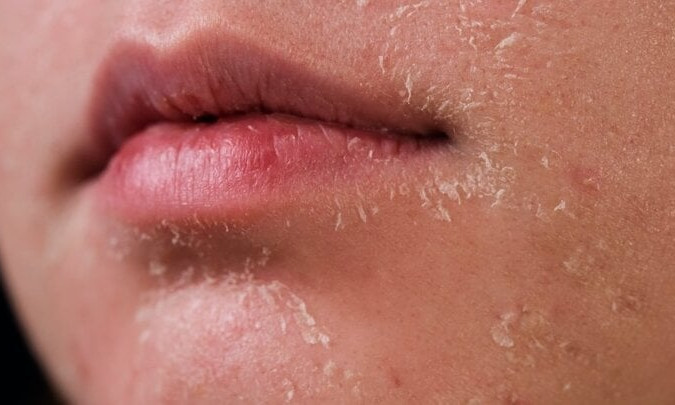 Sai lầm thường gặp khi chăm sóc da mùa đông