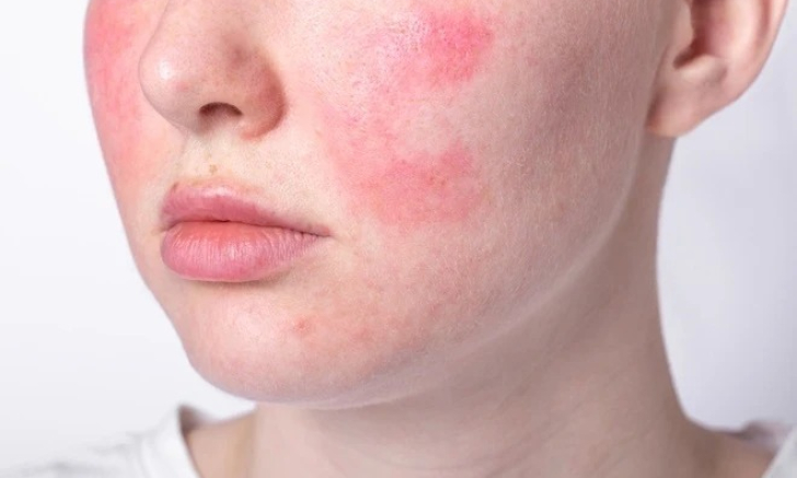 4 bệnh về da dễ bùng phát khi trời lạnh