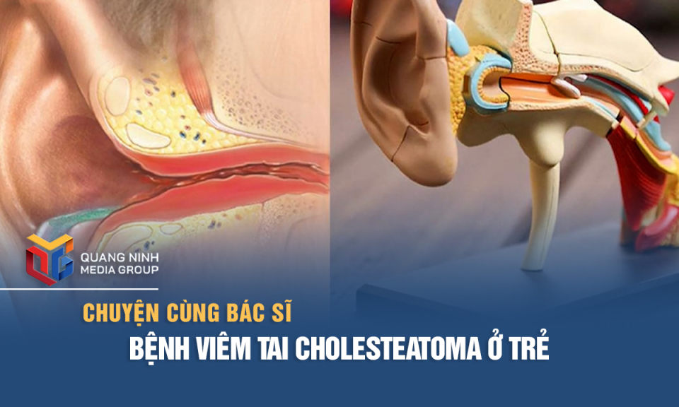 Bệnh viêm tai Cholesteatoma ở trẻ