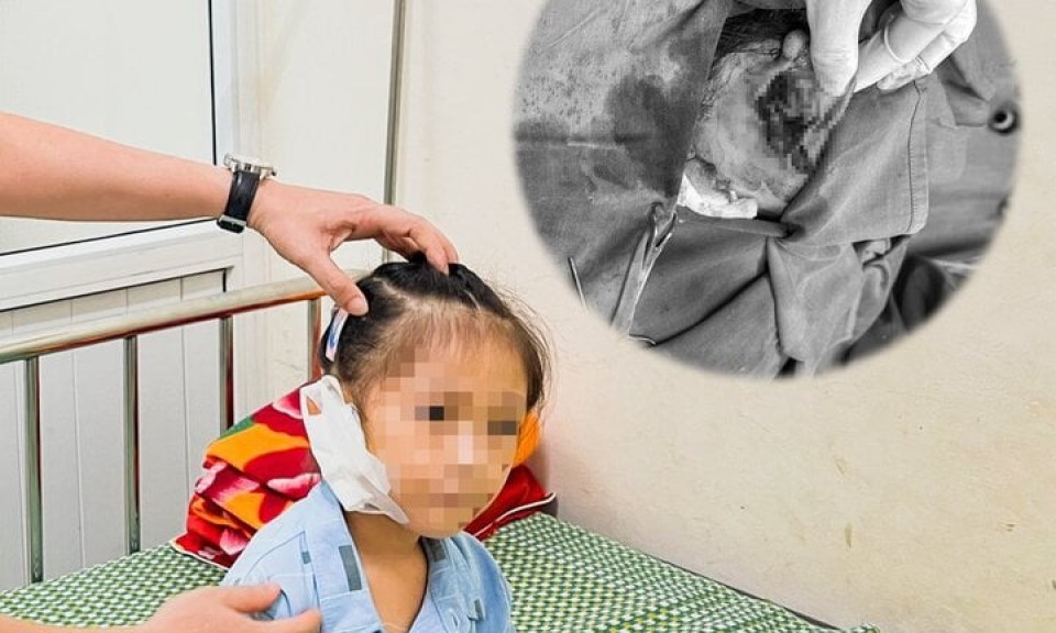 Bé gái 6 tuổi đứt tai vì kính vỡ trong lúc chơi đùa ở nhà 