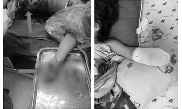 Hàng xóm đốt pháo, bé gái ở TP.HCM bị mất bàn tay