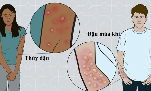 Phân biệt thủy đậu và đậu mùa khỉ