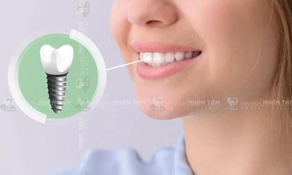 Trồng răng Implant – Cứu tinh cho người bị mất răng