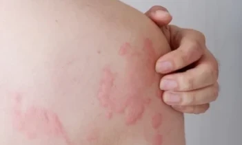 Gia tăng ca mắc bệnh hô hấp, da liễu trong thời tiết nồm ẩm