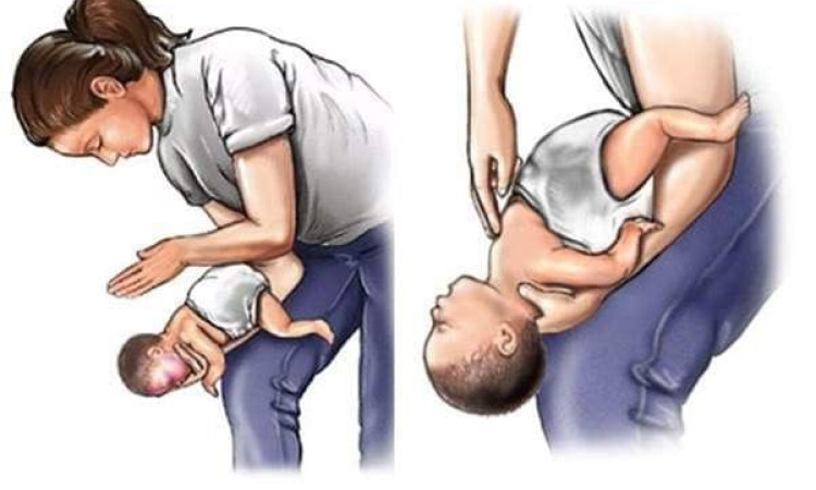 Bác sĩ hướng dẫn cách giúp trẻ thoát hiểm khi hóc dị vật đường thở