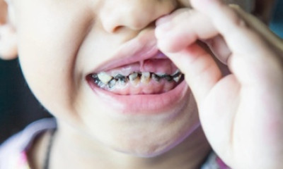 Lý do bất ngờ khiến trẻ con luôn bị sâu răng