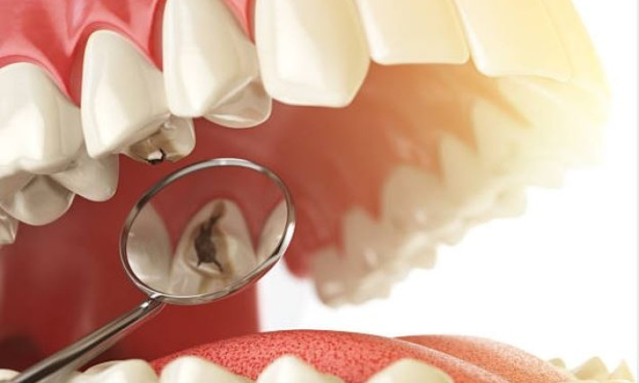 Vì sao đánh răng hàng ngày vẫn bị sâu răng?