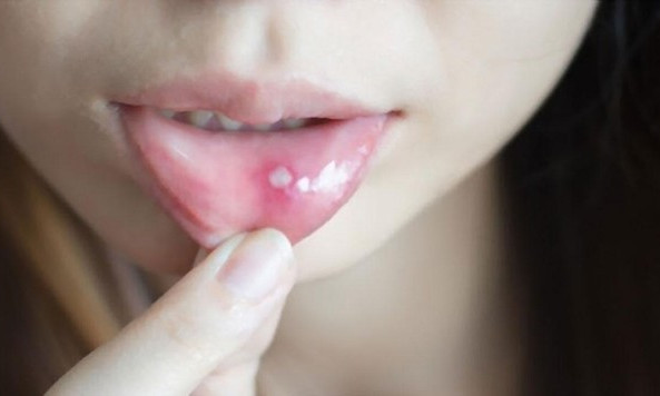 Cách xử lý nhiệt miệng tại nhà cực đơn giản