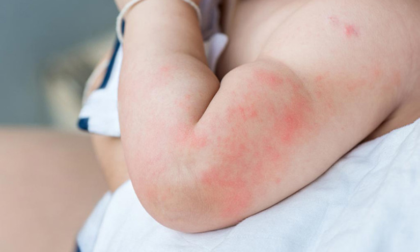 Viêm da ở trẻ trong mùa nắng nóng phòng tránh thế nào?