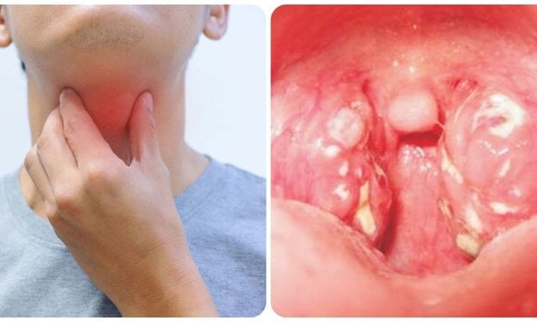 Các biến chứng khó lường của bệnh bạch hầu