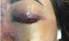 Nữ bệnh nhân 30 tuổi gần như bị mù sau khi tiêm filler làm đẹp 
