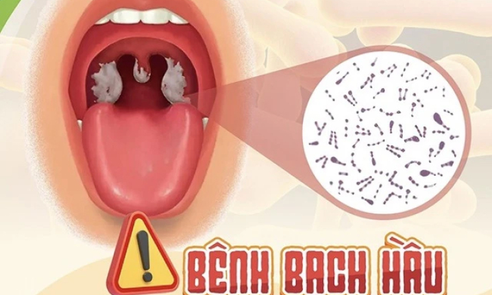 Không để lây lan, bùng phát bệnh bạch hầu 