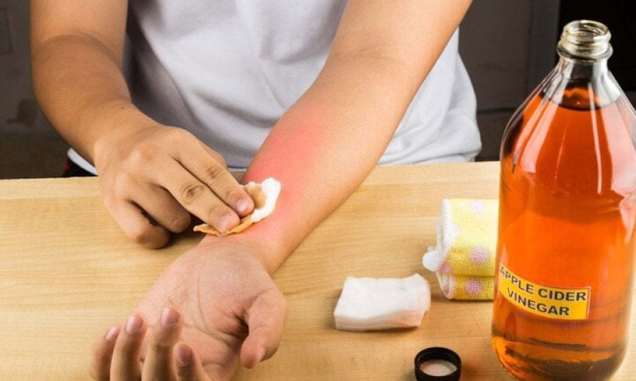 Cách làm dịu tay bỏng rát do dính ớt