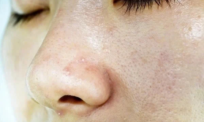 Chăm da dầu không quá khó nếu biết những lưu ý này